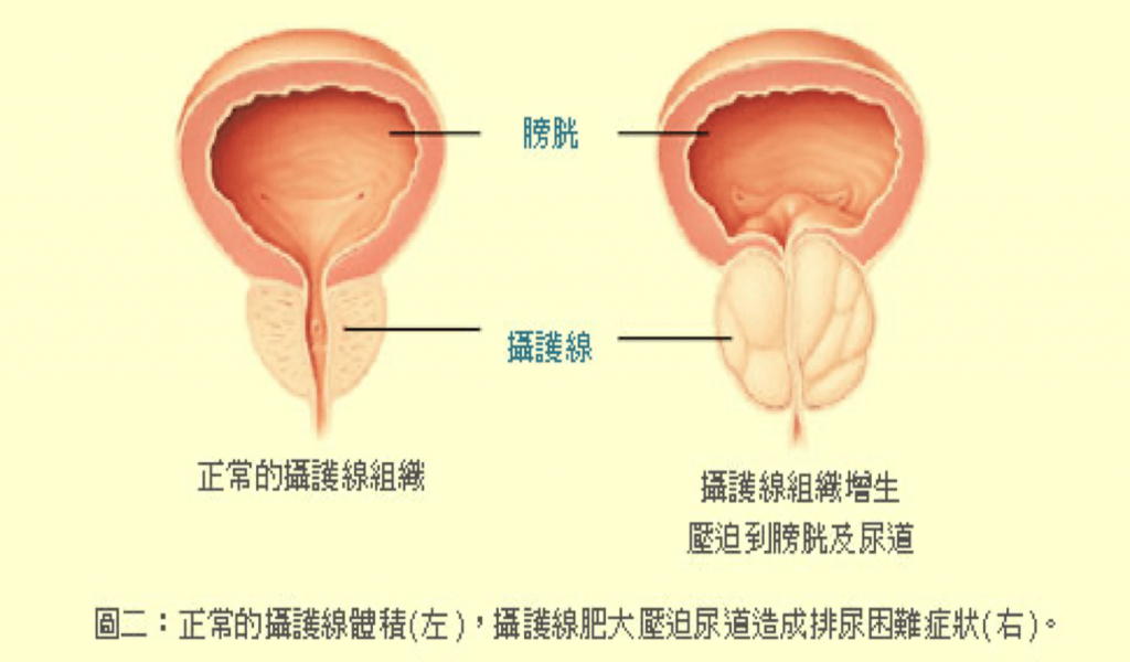 攝護腺病理圖